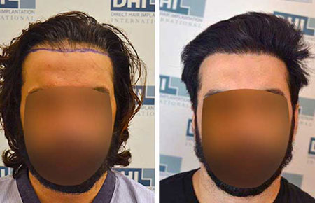 noida hair transplant before and after