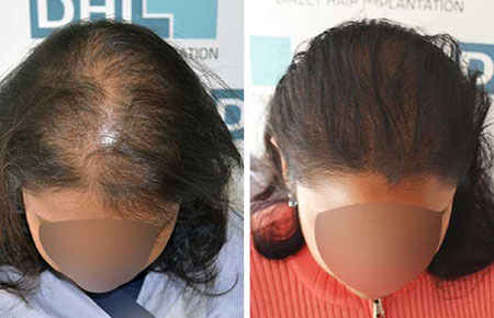 Delhi hair transplannt results