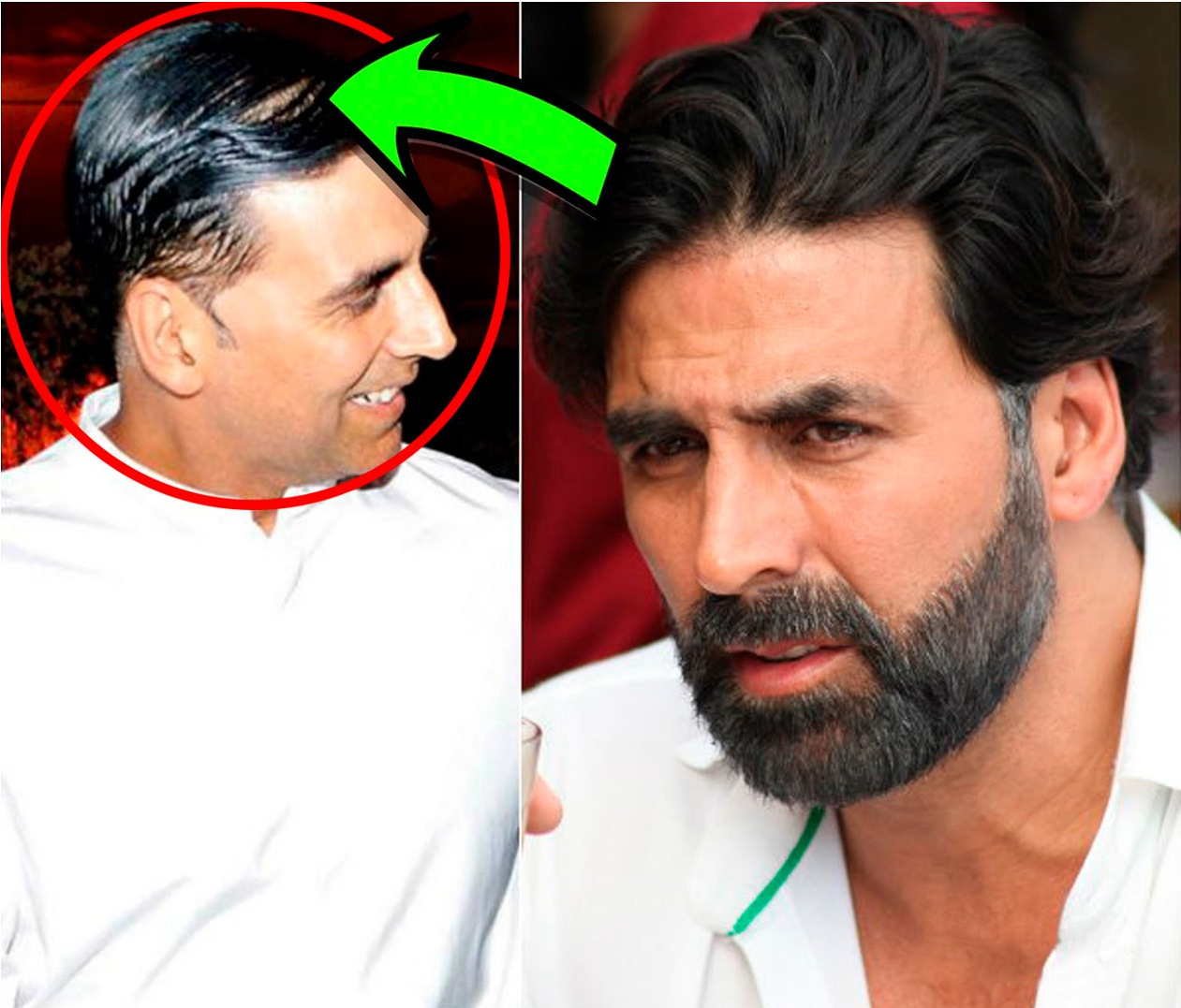 Is Ranbir Kapoor losing hair?