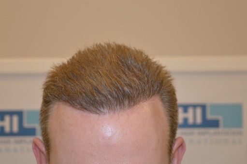 What does a hair transplant repair cost
