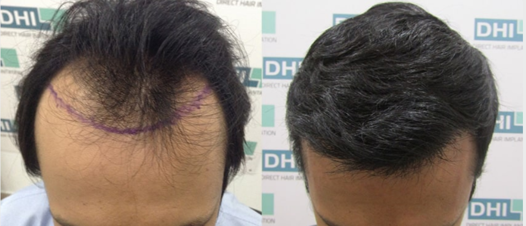 How Much Does Hair Transplant Cost Dhi International