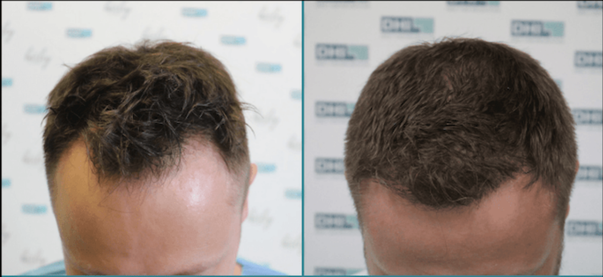 How Much Does Hair Transplant Cost? - DHI International