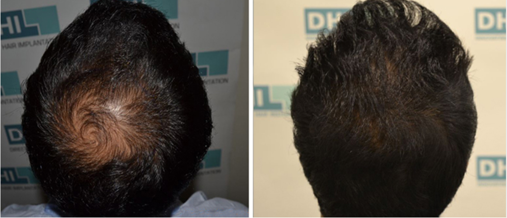 How Much Does Hair Transplant Cost Dhi International