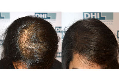 Womans Astonishing Hair Growth with PRP Hair Loss Treatment  Este