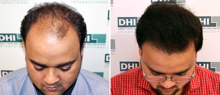 dhi gives natural hairline