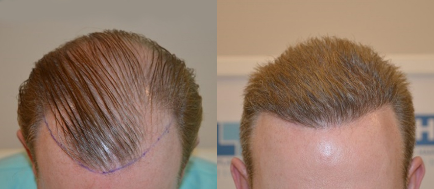 Facial Hair Transplant Before and After Photos  Foundation For Hair  Restoration