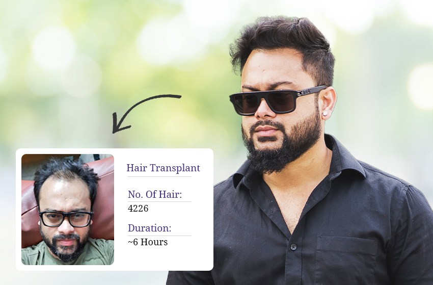 best hair transplant india