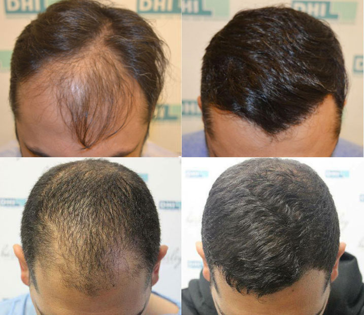 DHI Hair Transplant Clinics Offers Price Per Follicle Cost Graft Rate