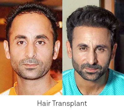 Which is the best hair transplant clinic in India  Quora