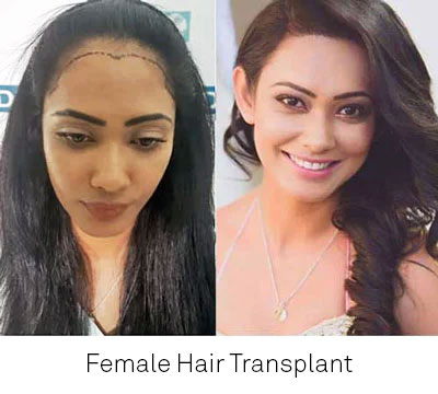 Hair Bonding in Chennai  NonSurgical Hair Replacement