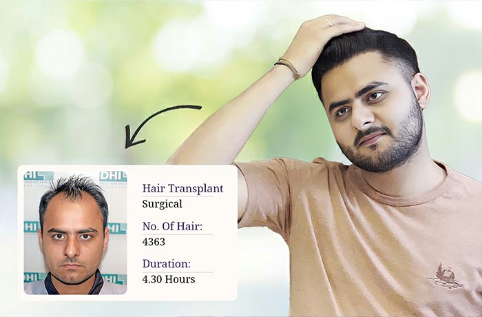 direct-hair-implantation