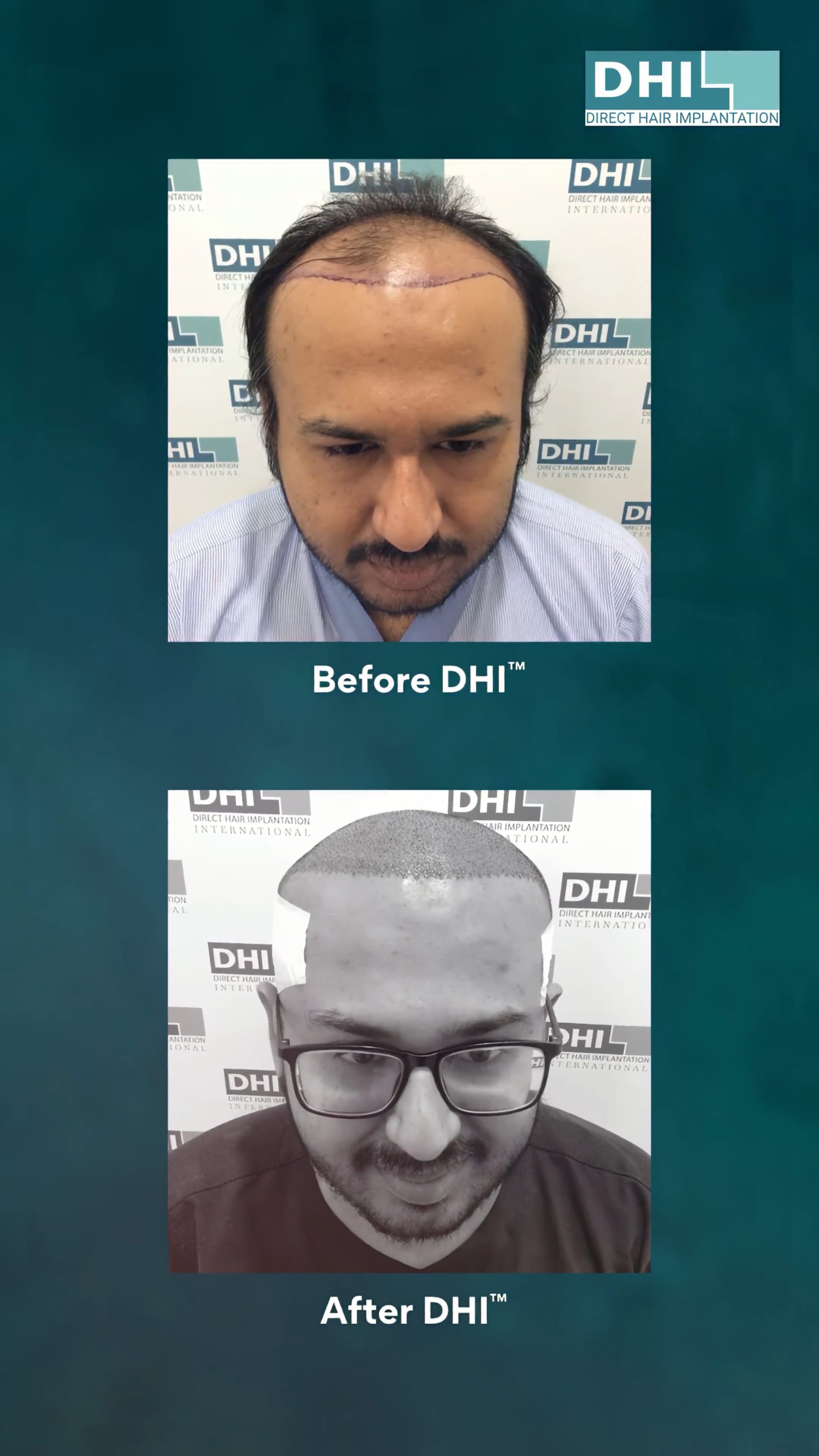 hair transplant video 1