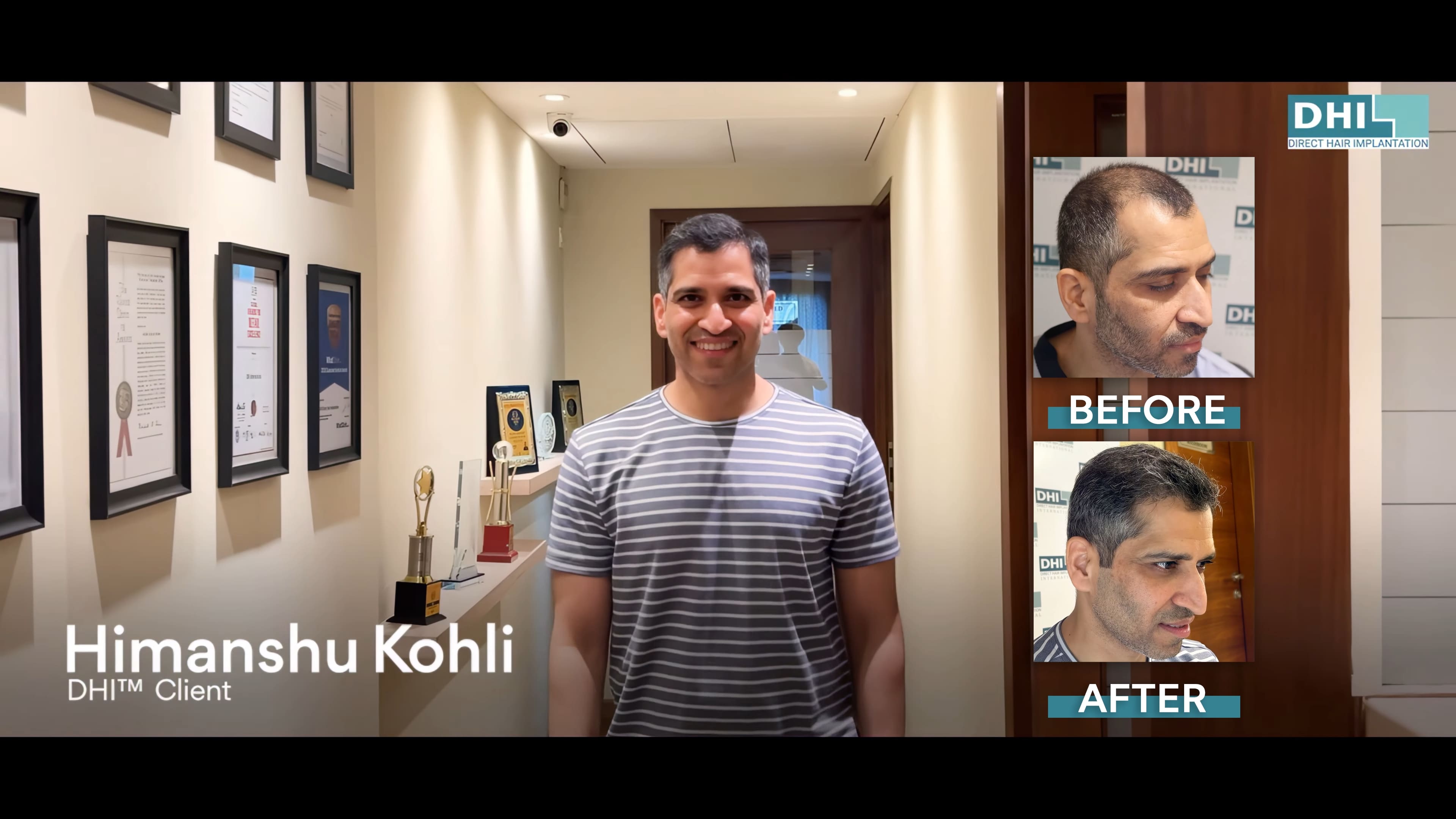 hair transplant video 1