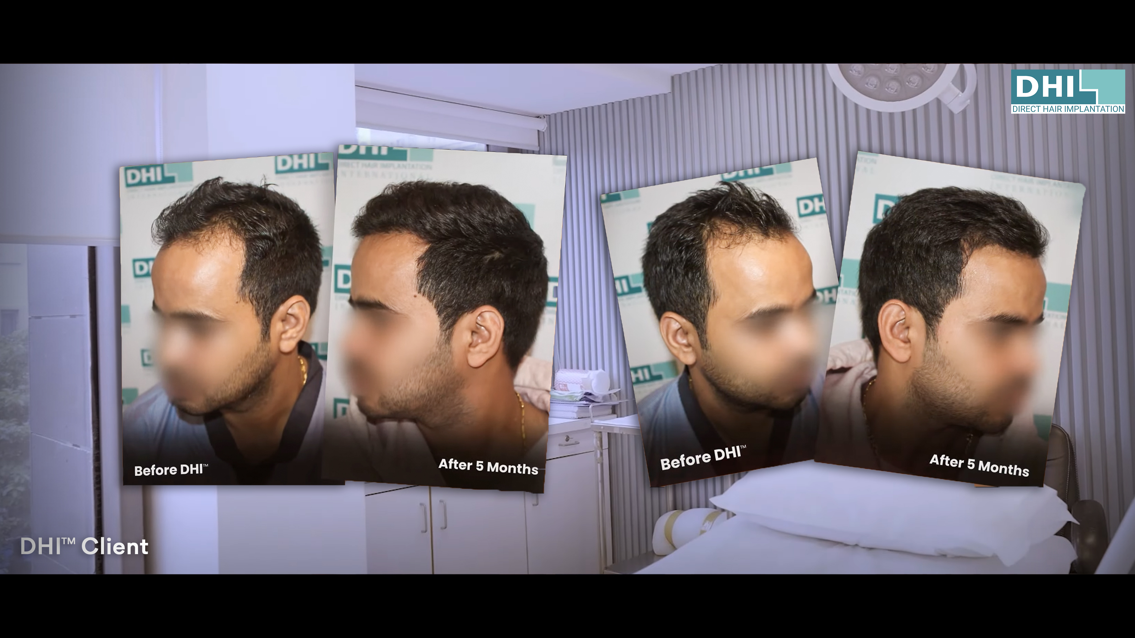 hair transplant video 1