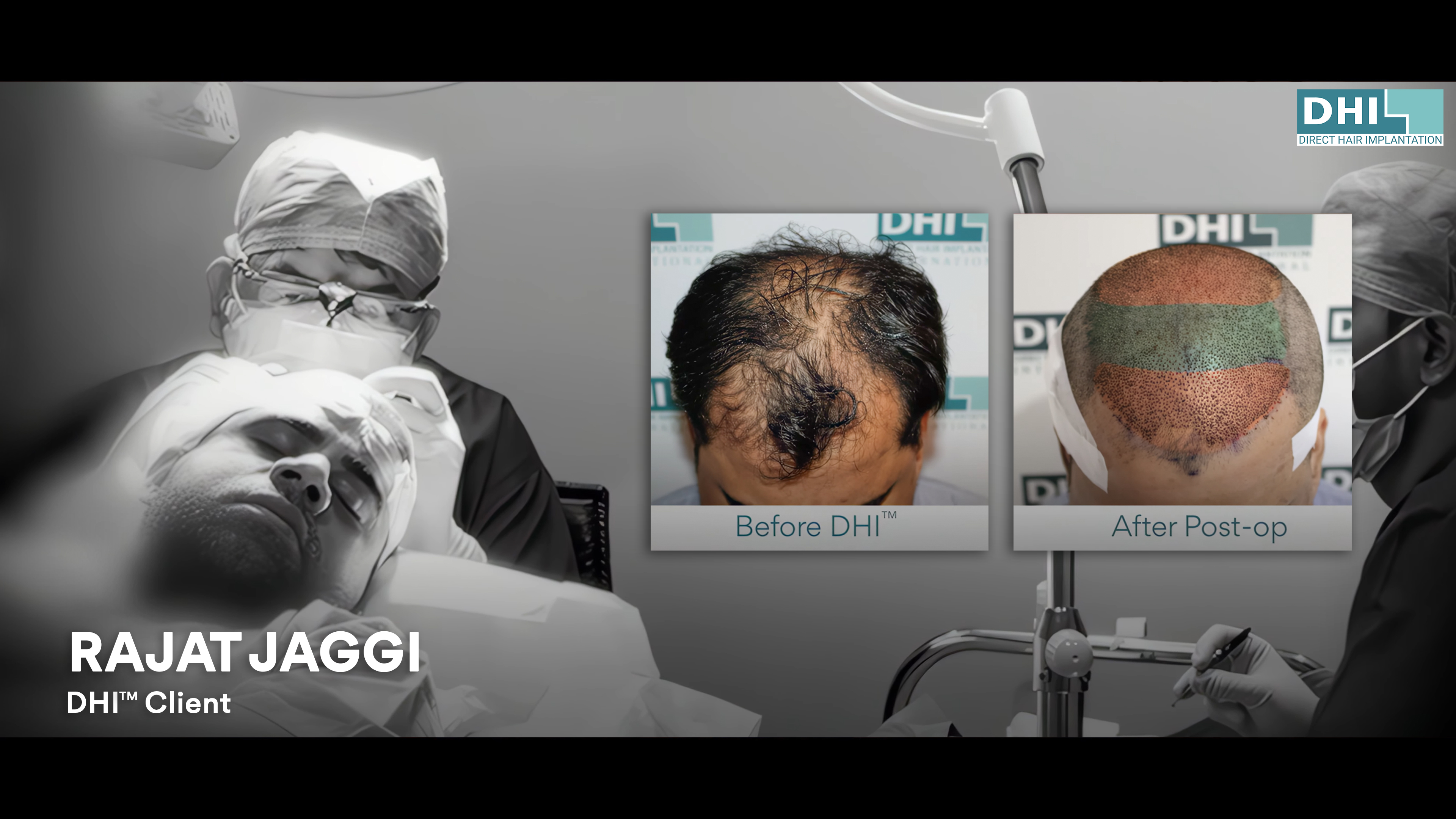 hair transplant video 1