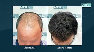 hair transplant video 1