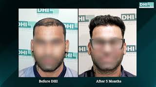 hair transplant video 1