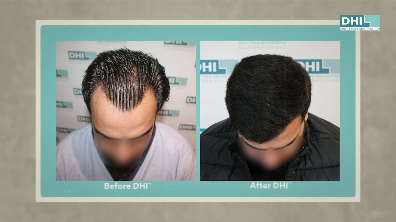 hair transplant video 1